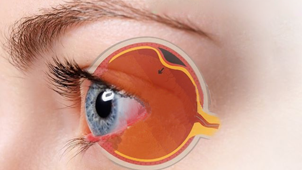 Deslocamento Retina